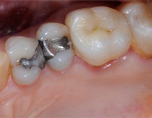 Amalgama e otturazioni - Dentista