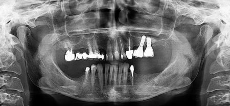 1-casi-clinici-impianti-dentali-biella